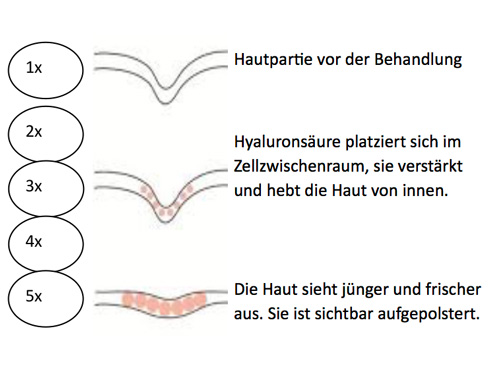 Foto einer Micro Needling Kur